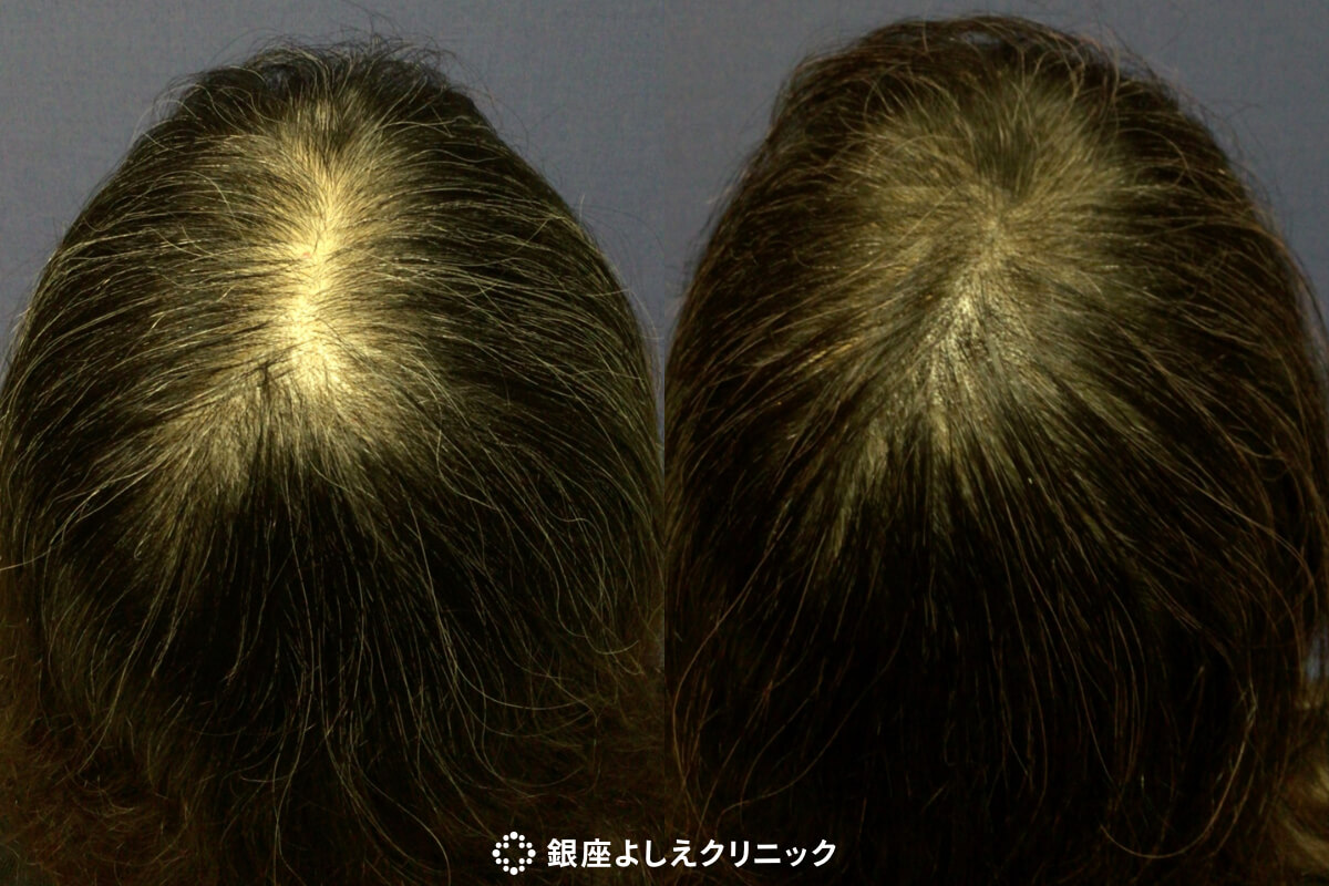 CPC毛髪再生プラス2クール 施術前 / 施術後