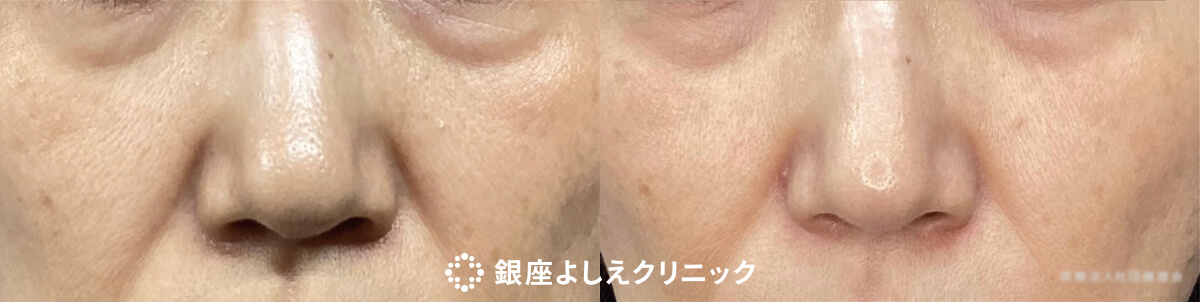 CPC-PRP（高濃度プレミアムPRP） 3クール 施術前 / 施術後