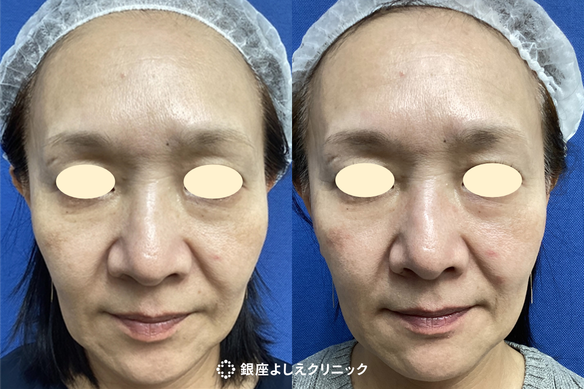 線維芽細胞治療　5㏄　1回（全顔） 施術前 / 施術3ヶ月後