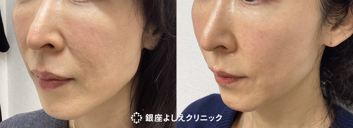 線維芽細胞治療　5㏄　1回（全顔） 施術前 / 施術後