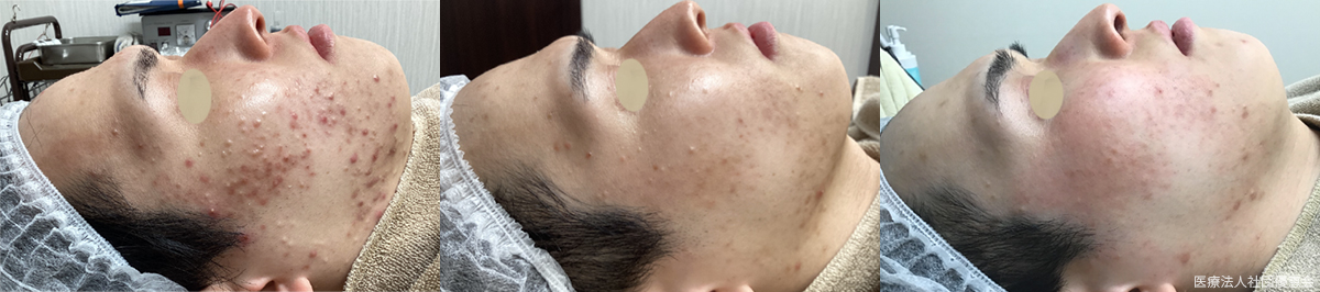 ジェネシス15回 ピーリング13回 30代男性 施術前 / 10回施術後 / 15回施術後