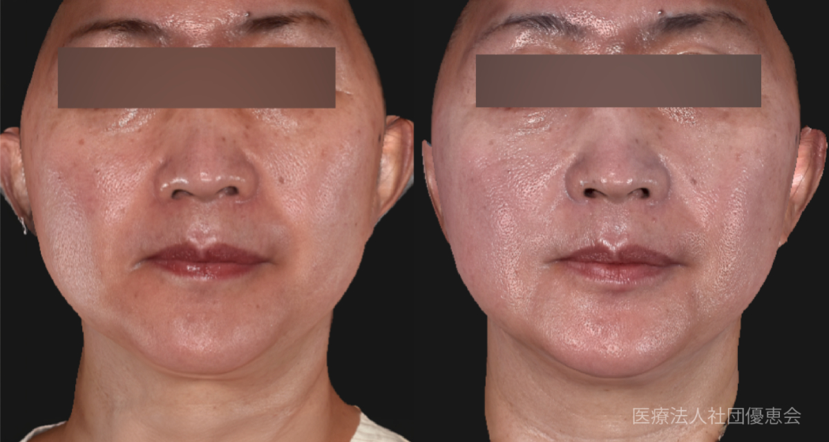 PrimeX（全顔）1回　50代女性 施術前 / 施術後