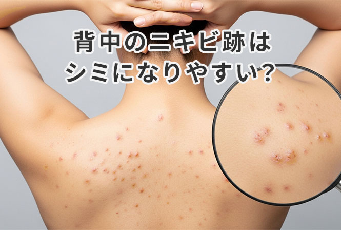 背中のニキビ跡はシミになりやすい?色素沈着(シミ)を消す方法とは