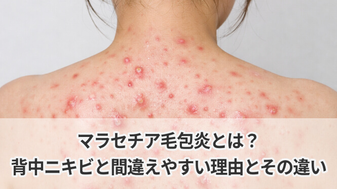 マラセチア毛包炎とは?背中ニキビと間違えやすい理由とその違い