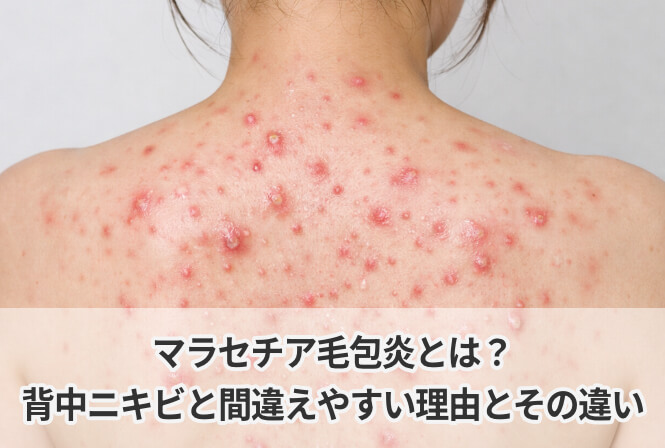 マラセチア毛包炎とは?背中ニキビと間違えやすい理由とその違い