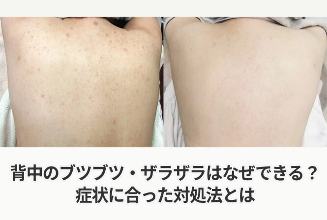 背中のブツブツ・ザラザラはなぜできる?症状に合った対処法とは