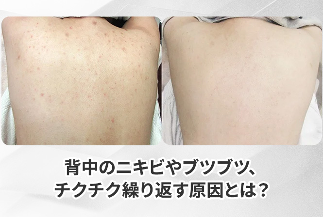 背中のニキビやブツブツ、チクチク繰り返す原因とは？