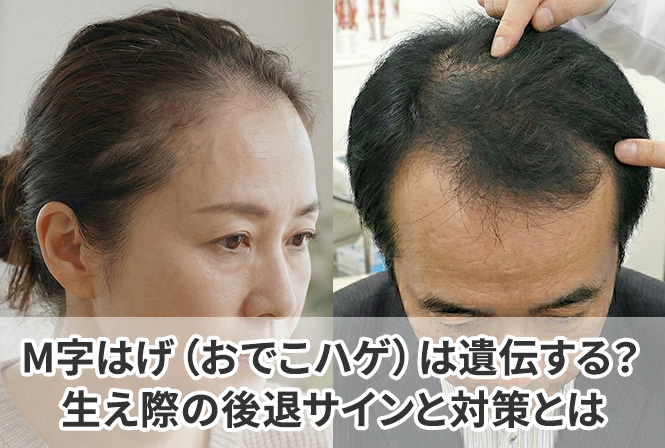 M字はげ(おでこハゲ)は遺伝する?生え際の後退サインと対策を解説します