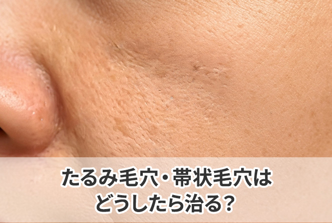 シワに見えるたるみ毛穴・帯状毛穴はどうしたら治る？