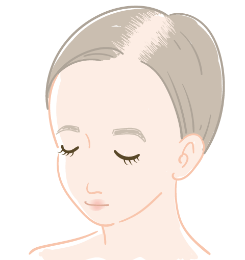 FAGA(女性男性型脱毛症)