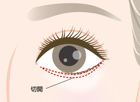 表ハムラ法