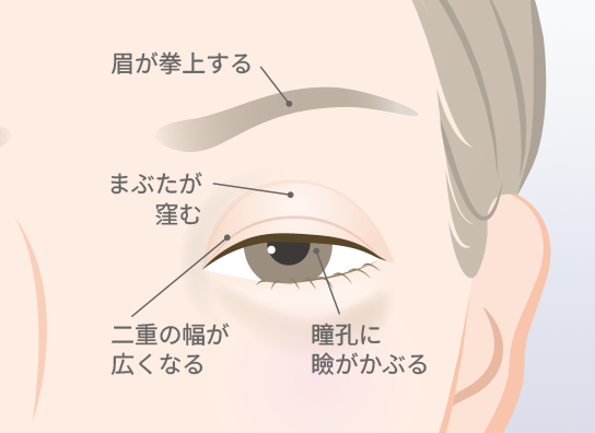 眼瞼下垂術