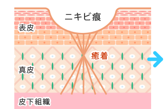 皮膚組織が癒着して固くなりクレーター状になる