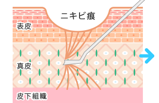 専用の針で癒着した組織を切り離す