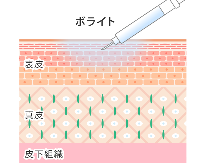 ボライト(ヒアルロン酸)を注入することで再癒着を防止してクレーターを改善