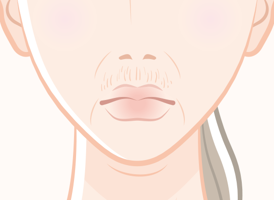 鼻の下のしわ治療の特徴